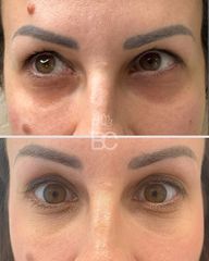 Blefaroplastia