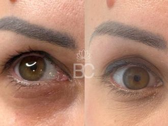 Blefaroplastia antes y después - 876890
