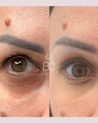 Blefaroplastia