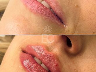 Aumento labios antes y después - 876892