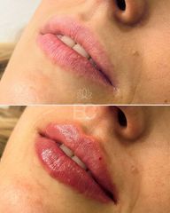Aumento de labios
