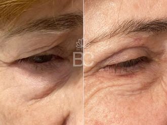 Blefaroplastia antes y después - 876893