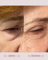 Blefaroplastia