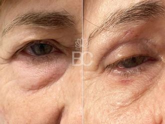 Blefaroplastia antes y después - 876894