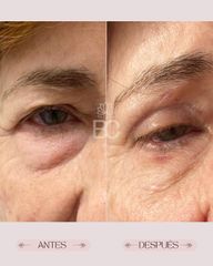 Blefaroplastia