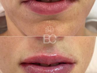 Aumento labios antes y después - 876895