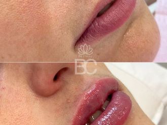 Aumento labios antes y después - 876896