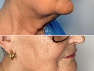 Liposucción de papada antes y después - 876897