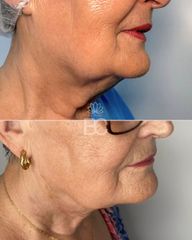 Eliminación de papada