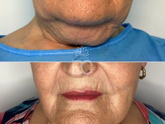 Liposucción de papada antes y después - 876898