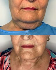 Eliminación de papada