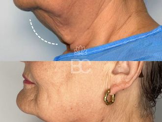 Liposucción de papada antes y después - 876899