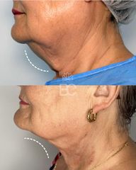 Eliminación de papada