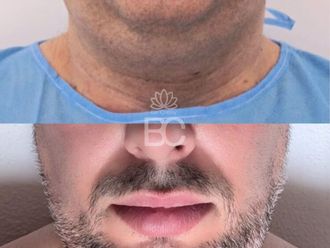 Liposucción de papada antes y después - 876900