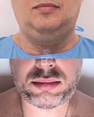 Eliminación de papada