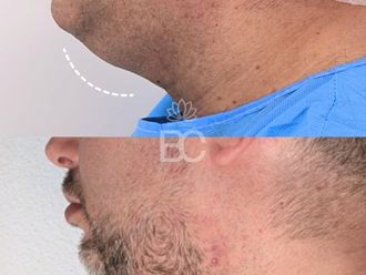 Liposucción de papada antes y después - 876901