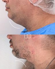 Eliminación de papada