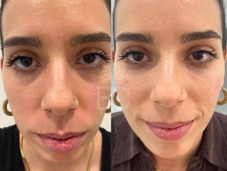 Rellenos faciales antes y después - 876902