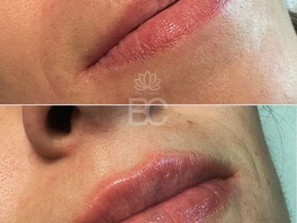 Aumento labios antes y después - 876903