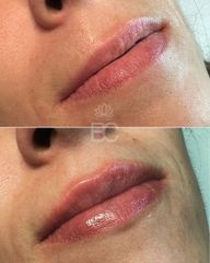 Aumento de labios