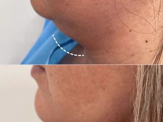 Liposucción de papada antes y después - 876905