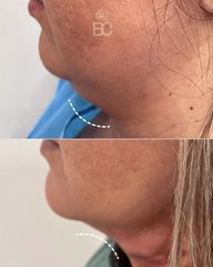 Eliminación de papada