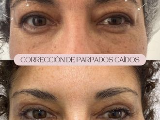 Blefaroplastia antes y después - 876906