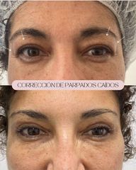Blefaroplastia
