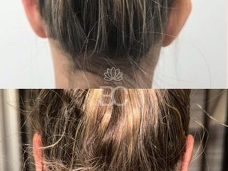 Otoplastia antes y después - 877150