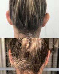 Corrección lóbulos orejas