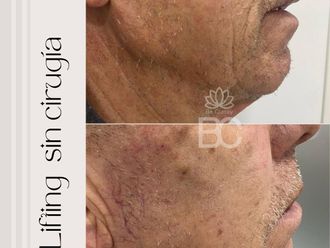 Lifting sin cirugía antes y después - 877807