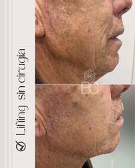 Lifting sin cirugía