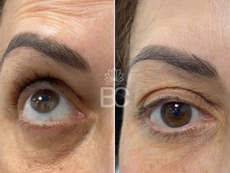 Eliminación ojeras antes y después - 877808