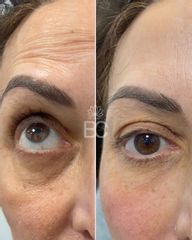 Eliminación de ojeras