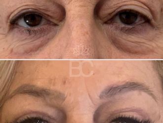 Blefaroplastia antes y después - 878154
