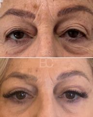 Blefaroplastia