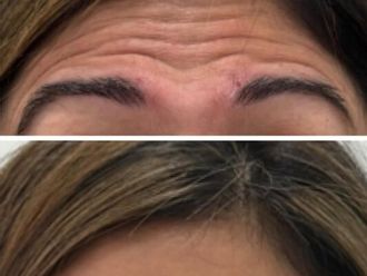 Eliminación arrugas antes y después - 878155