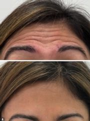 Corrección de arrugas