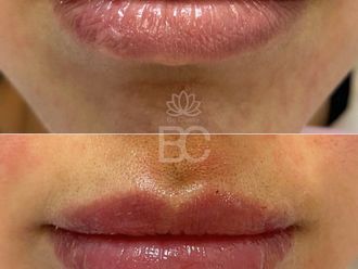 Aumento labios antes y después - 878537