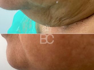 Liposucción de papada antes y después - 878538