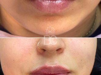 Aumento labios antes y después - 878865