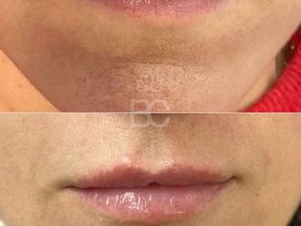 Aumento labios antes y después - 879346