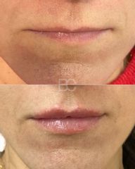 Aumento de labios