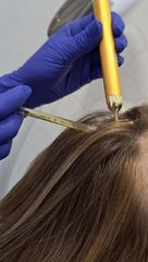 Mesoterapia Capilar