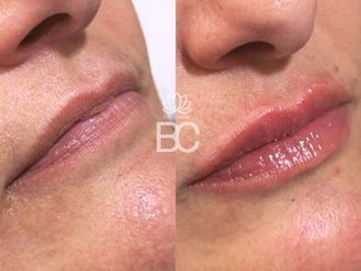 Aumento labios antes y después - 880257