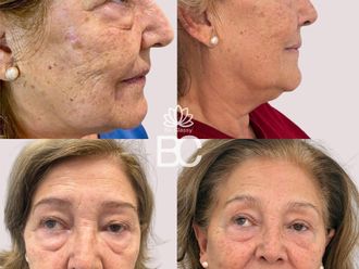 Rejuvenecimiento facial antes y después - 880260