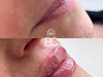 Aumento labios antes y después - 881025