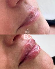 Aumento de labios - Be Classy
