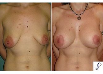 Antes y después Mastopexia 