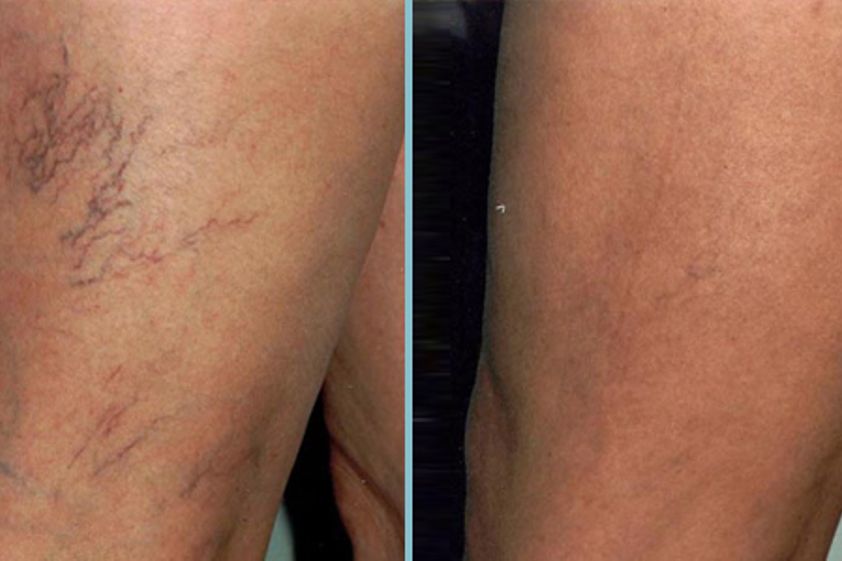 Tratamiento varices antes y después - 231484
